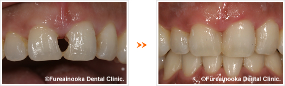 前歯のダイレクトボンディングの症例1