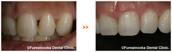 歯のすき間・ダイレクトボンディングの症例2